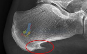 Close up detail of heel spur in foot