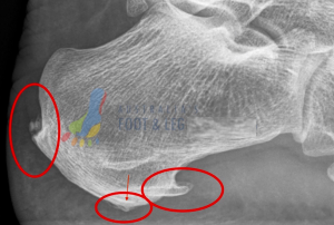 Plantar Fascial Heel Spur