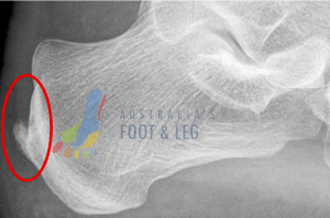 Posterior Heel Spur