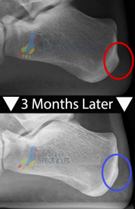 Heel Spur Treatment After 3 months