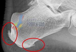 Plantar Fascial Heel Spur