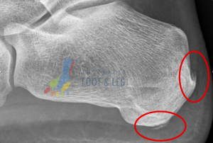 Plantar Fascial Heel Spur