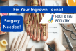 Perth: Fix Your Ingrown Toenail with Surgery – Today!